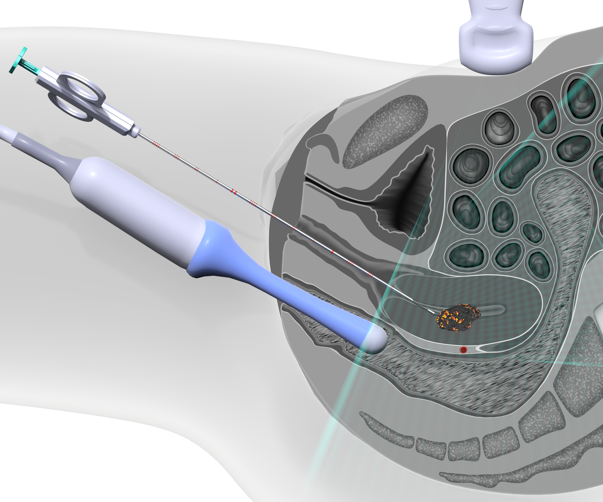 24-5-22   USG   Sagittal view   Pelvis - Peritoneum   CNB   Transcervical.png