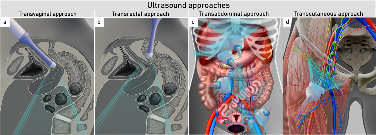 24-9-3   LN   Lymph-nodes   Infradiaphragmatic   Ultrasound-Approach.png