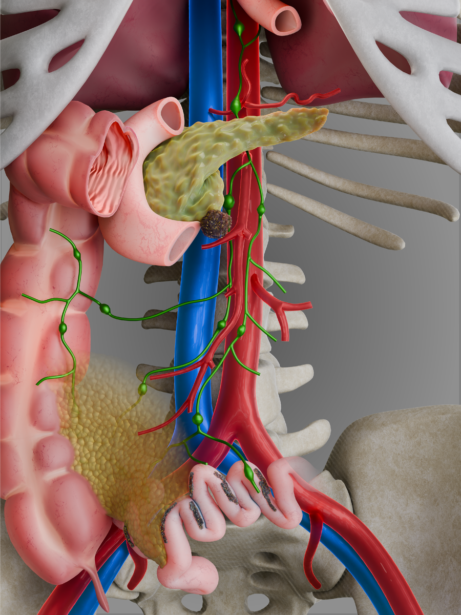 25-10-24   Lymphatic Abdominal Visceral Pathway + One Tumor + Background.png.png