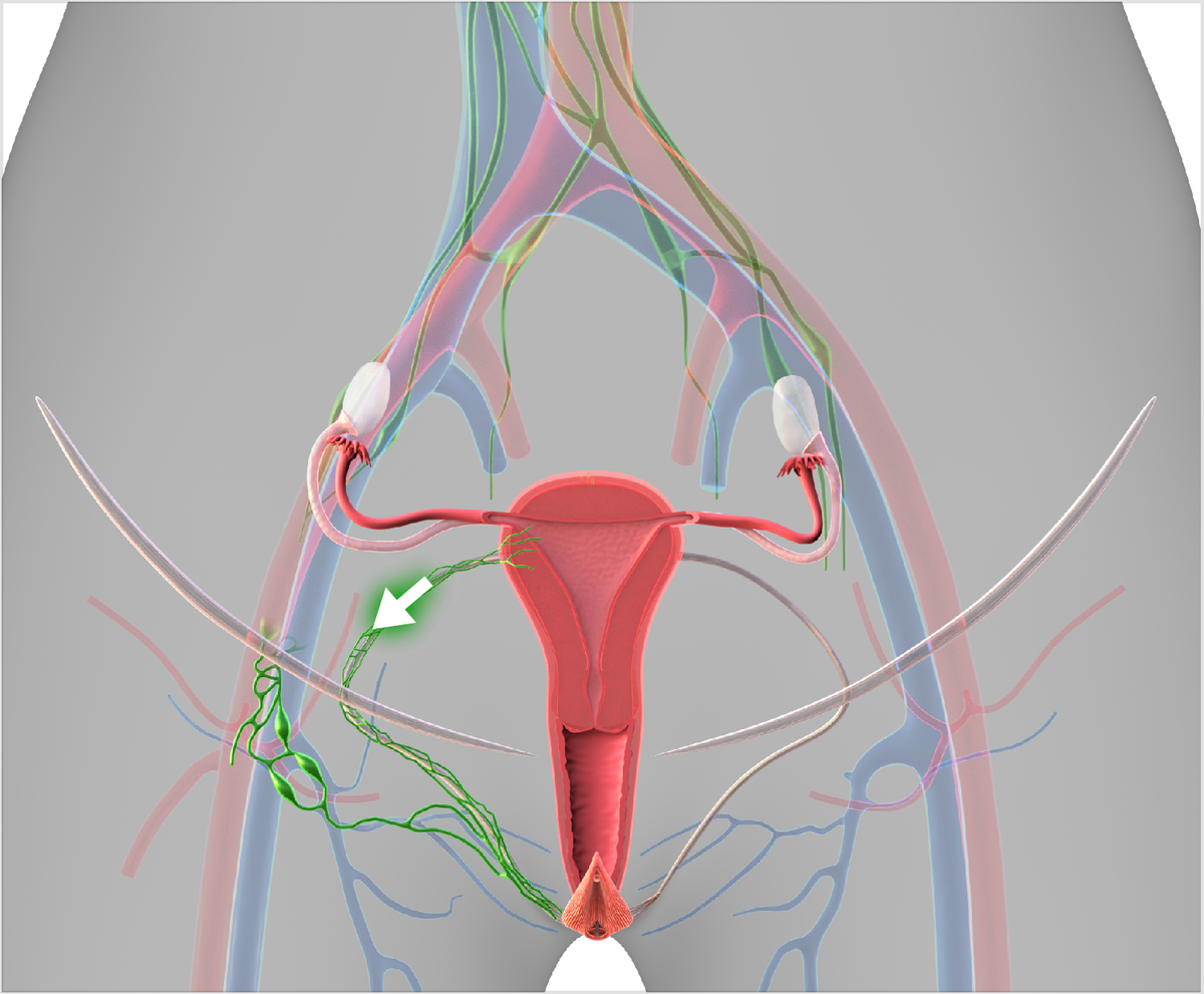 25-4-6   Scheme   Lymphatic Drainage - Round Ligament.png