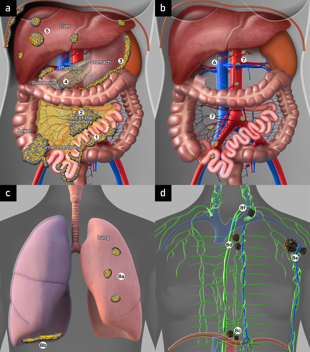 25-8-15   Collage   ISAAC 2025   Non resectability Carcinomatosis.png
