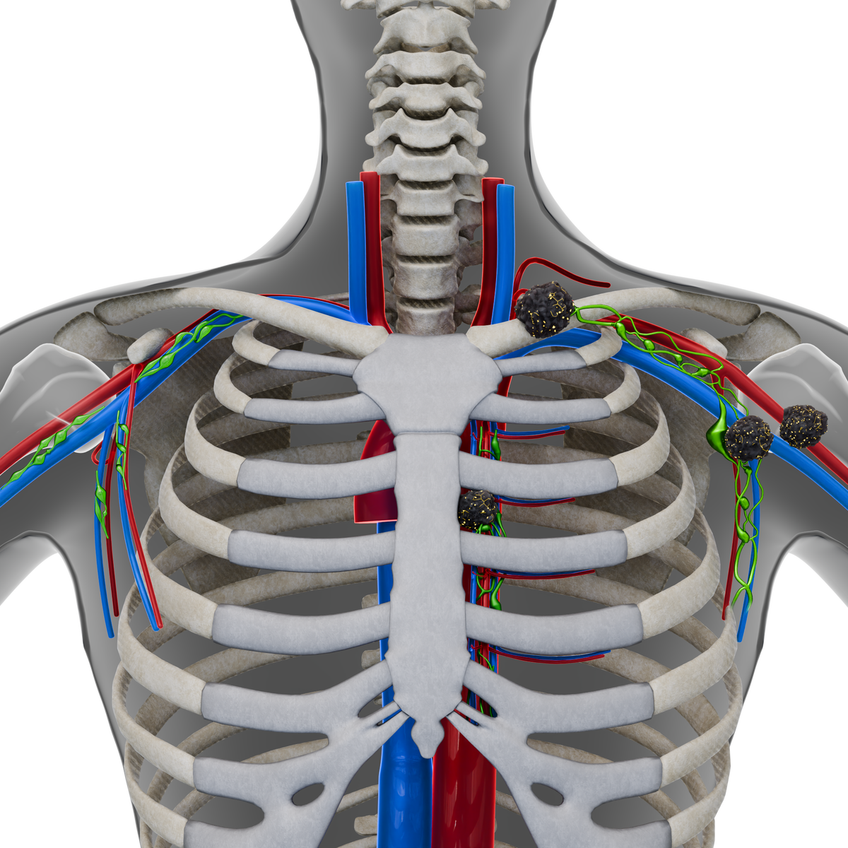 25-8-15   Coronal View - Other supradiaphragmatic LNs.png